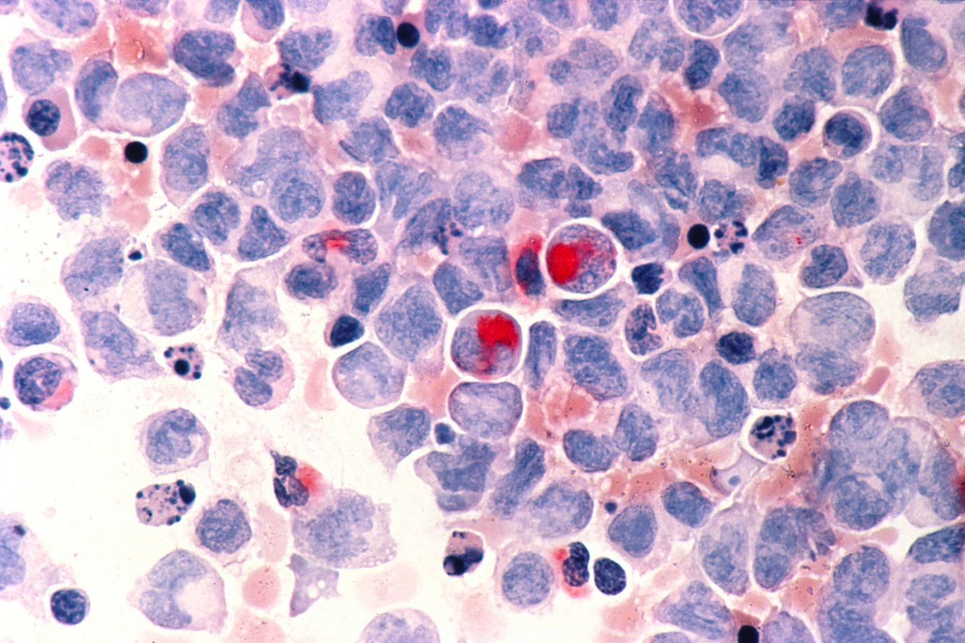 Acute myelocytic leukemia, AML