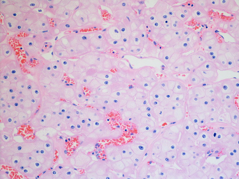 renal cell carcinoma, kidney cancer