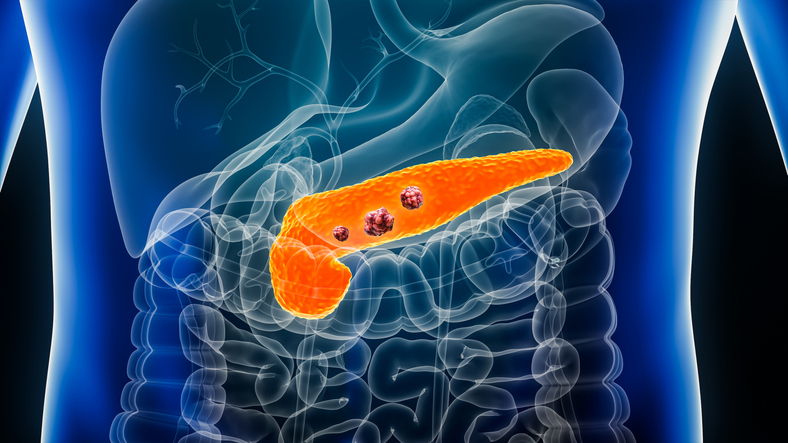 Revolution Medicines Reports ‘Unprecedented’ Survival in Pivotal Pancreatic Cancer Trial