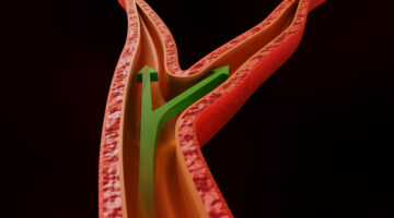 A 3D medical illustration of vascular constriction with white arrows indicating reduced and impeded blood flow. 3d rendering medical illustrastion.
