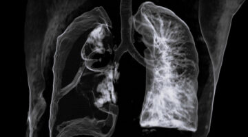 3D computed tomography (CT) scan of the chest of a 60 year old male patient with a pneumothorax, or collapsed lung. The right lung (seen on the left) has collapsed due to a build-up of air between the lung and chest wall. Pneumothorax can be due to trauma or lung rupture. It causes shortness of breath and pain on breathing. It is treated by inserting a tube to drain the air over a period of days, allowing the lung to re-inflate