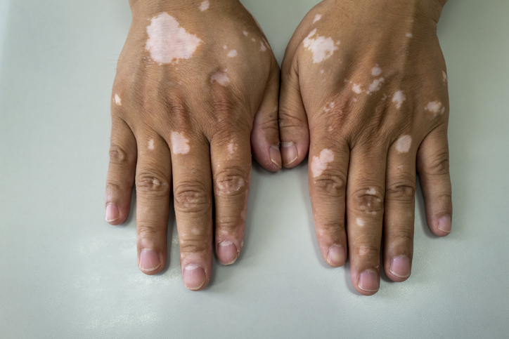 Pfizer Pill’s Phase 3 Data in Vitiligo Pave Way for FDA, EMA Submissions